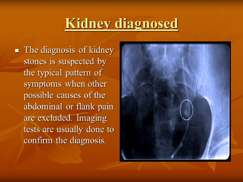 Kidney diagnosed The diagnosis of kidney stones is suspected by the typical pattern of